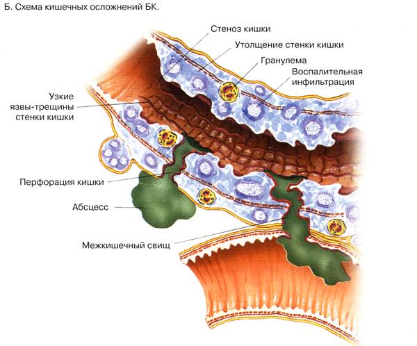 Как вылечить хронические воспалительные заболевания кишечника (Болезнь Крона и Язвенный коли)?